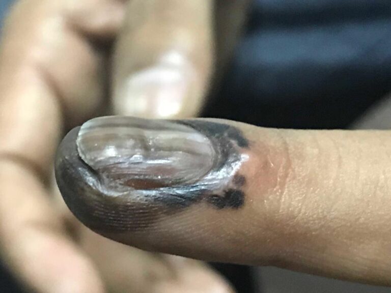 nail treatment